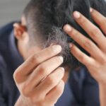 Haartransplantation: Das sollten Männer wissen